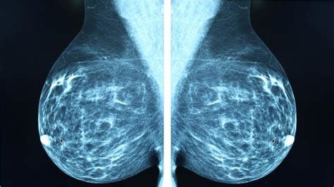 Do You Have Dense Breast Tissue What Does It Mean News Au