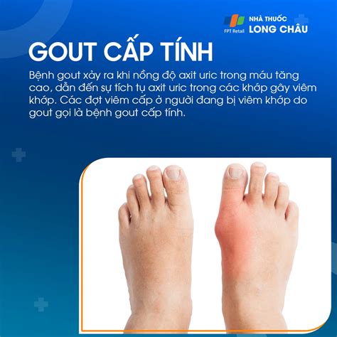 Gout cấp tính là gì Những vấn đề cần biết về gout cấp tính là gì