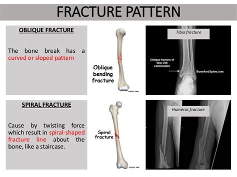 Types Of Fractures