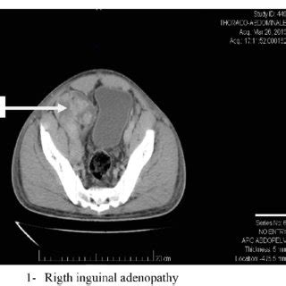 Right inguinal adenopathy with areas of necrosis. | Download Scientific Diagram