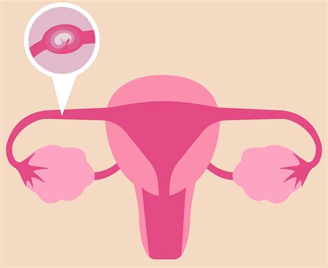 pregnancy  ectopic ashishveda