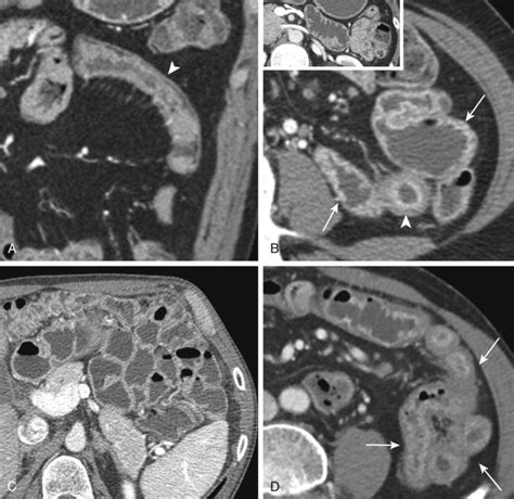 Computed Tomography Enterography Radiology Key