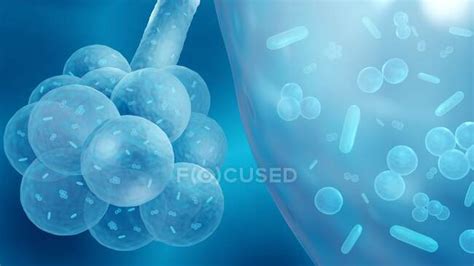 Illustration Of Bacteria Causing Bacterial Pneumonia In Alveoli