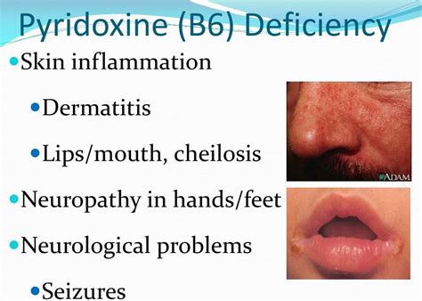 Vitamin B6 Deficiency Symptoms In Adults