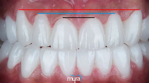 Principle Of Smile Design Treatment Evaluation For A Beautiful Smile