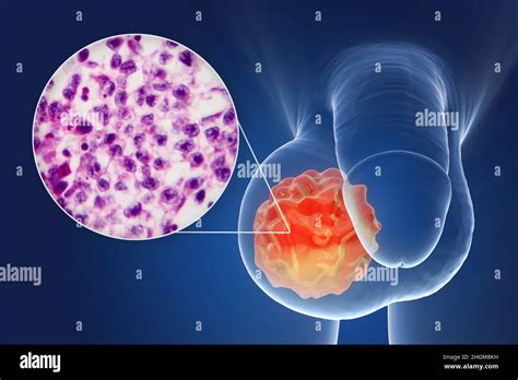 Testicular Cancer Illustration And Light Micrograph Stock Photo Alamy