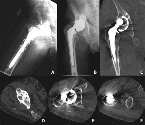 Metallosis Frog Leg Lateral Radiograph A Of A Revision Right Hip