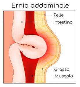 Ernia Crurale Cause Sintomi Pericoli E Cura