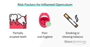 Inflamed Operculum - Share Dental Care