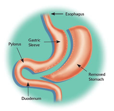 Laparoscopic Weight Loss Surgery Review