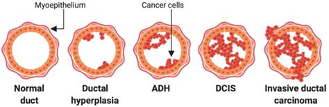 Stages Of Breast Cancer Development Tumour Cell Initiation And