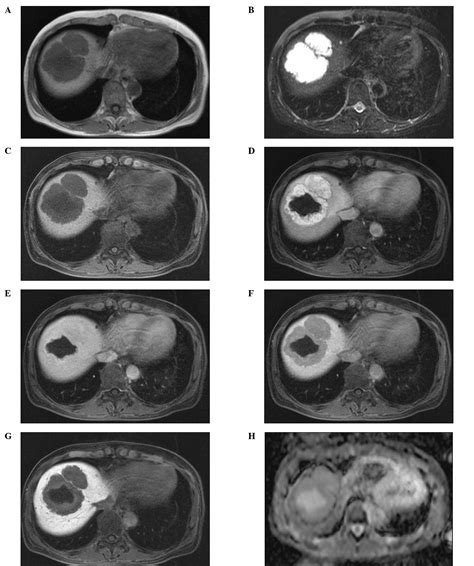 Liver Hemangioma Ultrasound