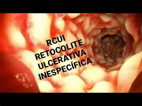 O que é a Retocolite ulcerativa inespecifica RCUI YouTube