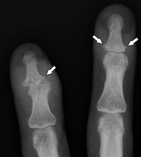 Differentiating Rheumatoid And Psoriatic Arthritis Of The Hand