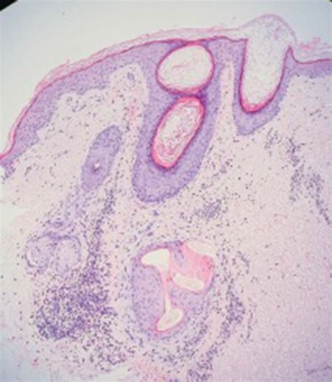 Dilated Hair Follicle Containing A Corkscrew Hair With Perifollicular