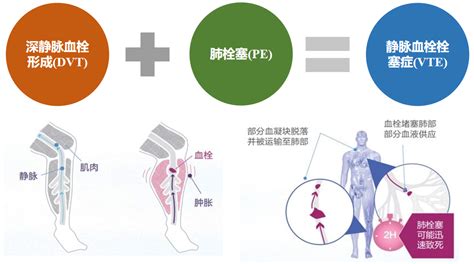 程哲教授：vte高风险贯穿整个肿瘤病程，肿瘤相关静脉血栓栓塞症引关注预防需要从哪几个方面考虑？用何种方法诊断？药物如何选择？ 头条 呼吸界