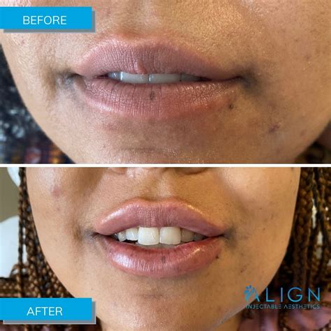 Before After Results Align Injectable Aesthetics