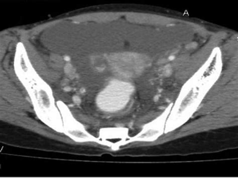 A 26 Year Old Woman With Pleural Effusion Hydronephrosis And Ascites