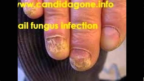 Causes of Candidiasis | how to treat candidiasis | www.candidagone.info ...