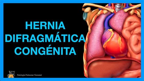 Hernia Diafragmatica Congenita Caracteristicas Imagenologicas En