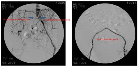 Endovascular Management Of Complex Critical Limb Ischemia In A Non Surgical Patient American