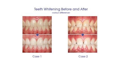 Teeth Whitening Before and After