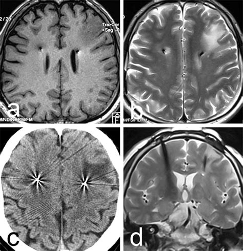 Case 5 A B The Intraoperative 3d T1 Weighted And T2 Weighted Images Download Scientific