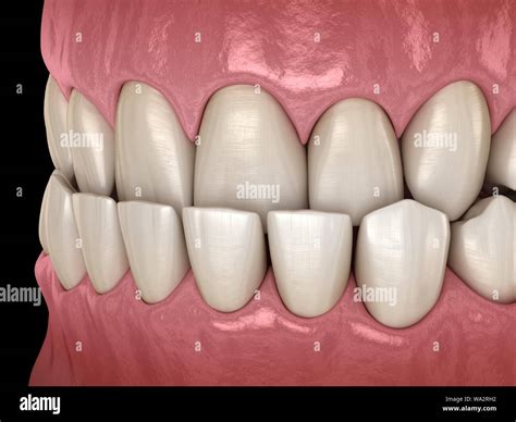 Underbite Dental Occlusion Malocclusion Of Teeth Medically