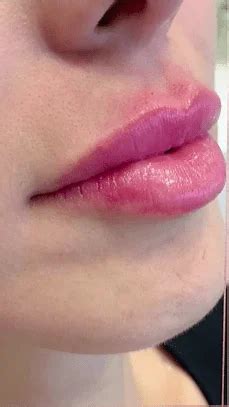 Lip Fillers Beverly Hills Wellness Center Med Spa