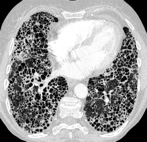 Review Provides Insights Into Pulmonary Hypertension Among Patients ...