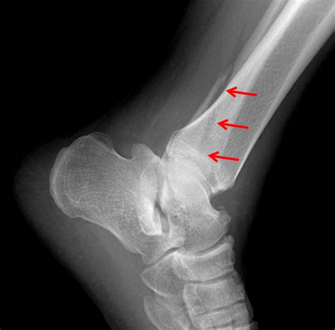 Weber B Fibular Fracture