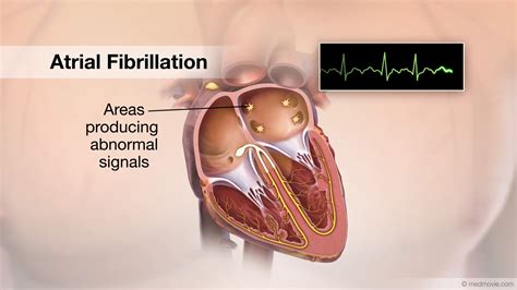 Ventricular Fibrillation Heart