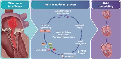 Illustration Of The Atrial Remodeling Process Due To Mitral Valve