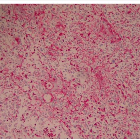 Positive Cd31 Markers Staining Of Angiosarcoma Download Scientific