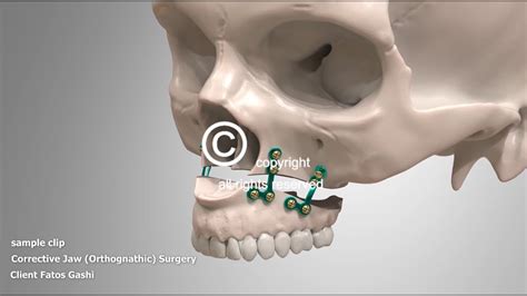 Corrective Jaw Surgery Orthognathic YouTube