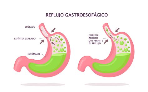 Cómo se cura el reflujo gastroesofágico Dieta medicamentos y cirugía