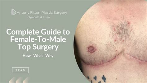 Complete Guide To Ftm Top Surgery Plymouth Truro