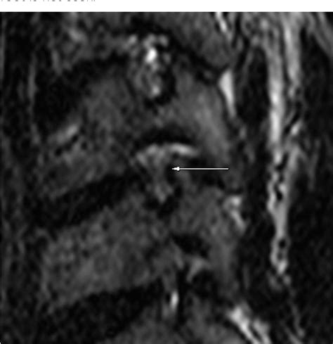 Figure 1 From A Practical Mri Grading System For Cervical Foraminal