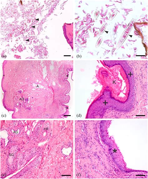 Pharyngeal Dermoid Cyst Causing Partial Upper Airway Obstruction In A