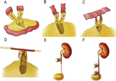 Laparoscopic Yang Monti Ureteral Reconstruction In Children Urology