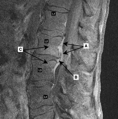 Spinal Epidural Abscess With Discitis And Vertebral Osteomyelitis