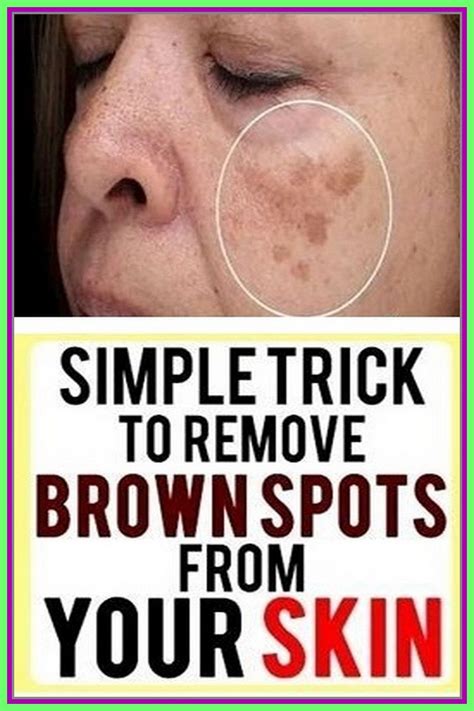 Face brown spots removal – Artofit