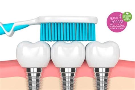 ¿Qué cuidados necesita un Implante Dental? - Tirma López Clínica Dental