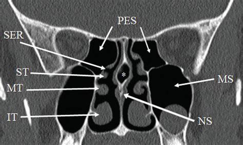 Paranasal Sinus Anatomy What The Surgeon Needs To Know Intechopen