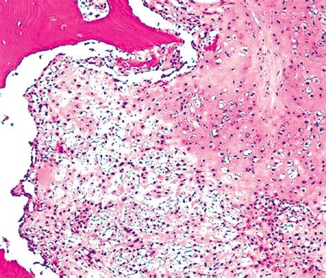 Pathology Outlines - Clear cell chondrosarcoma