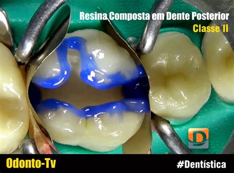 Dent Stica Resina Composta Em Dente Posterior Classe Ii Odonto Tv