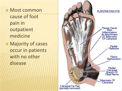 Ppt Plantar Fasciitis Calcaneal Spur And Tendo Achillitis Powerpoint Presentation Id1935401