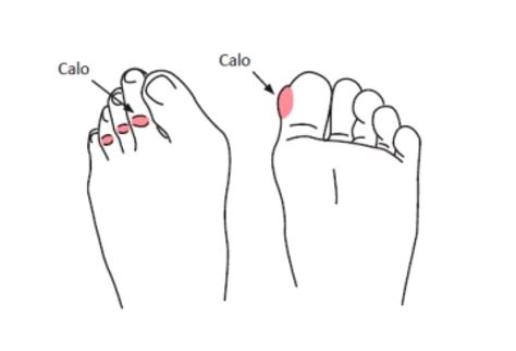 Como Tirar Um Calo Do Dedo Do Pé - Calo no pé: saiba o que é, como tratar e prevenir