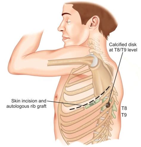 T8 T9 Spinal Disc