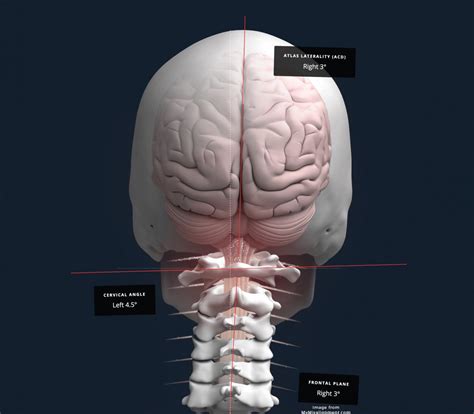 Upper Cervical Misalignment